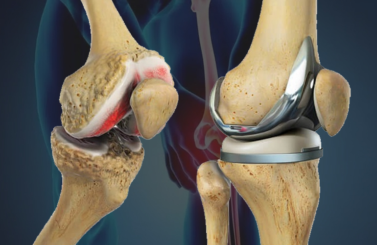 Unicondylar Knee Replacement Surgeon in Ahmedabad, Partial Knee Replacement Surgeon in Ahmedabad, Microplasty Knee Replacement Surgeon in Ahmedabad, Microplasty Knee Replacement Surgeon in Gujarat