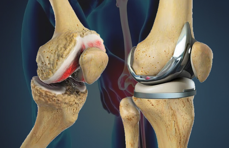 totalkneereplacement